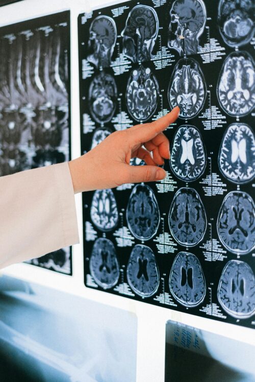 10 najczęstszych chorób mózgu. Kluczowe wyzywania dla zdrowia i funkcjonowania